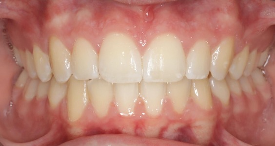 After Teeth
